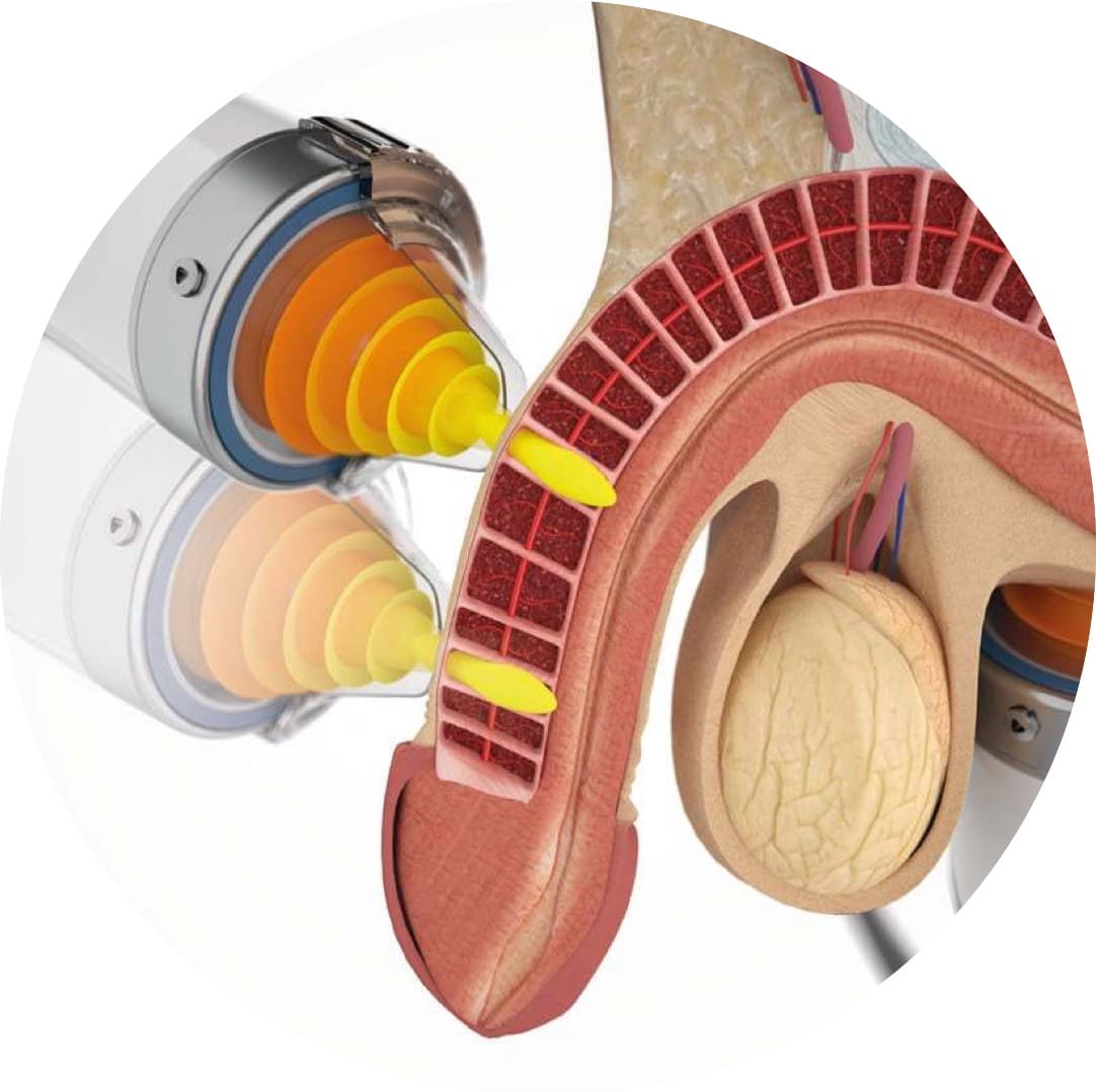 The focused shockwave applicator used at the CoreGood Kāpiti clinic