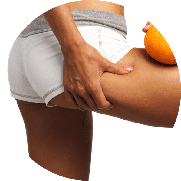 What Causes Cellulite?